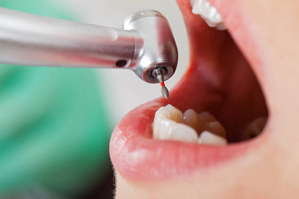 Best Emergency Treatment for Oral Infections in Tuskegee, AL